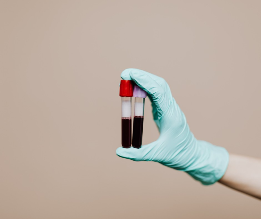 Bloed- en speekseltest hormonen – voorbeeld van hormoontest via bloedbuisje